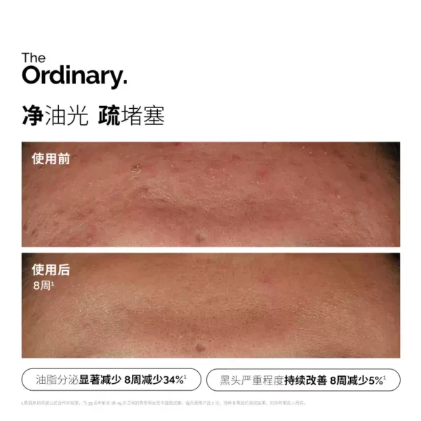 O1CN0170RRee1zk0vCplnGj_2214222556751.jpg_q50.jpg_.webp The Ordinary10%烟酰胺+1%锌提亮控油收毛孔淡化痘印胺锌三控精华